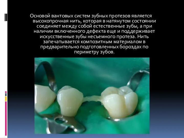Основой вантовых систем зубных протезов является высокопрочная нить, которая в натянутом состоянии