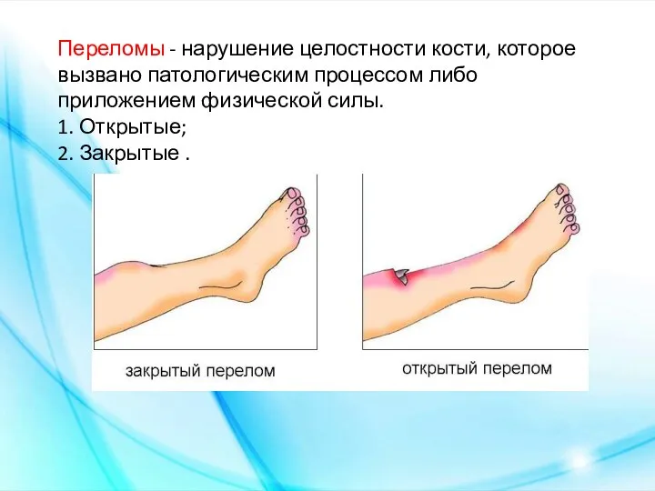 Переломы - нарушение целостности кости, которое вызвано патологическим процессом либо приложением физической