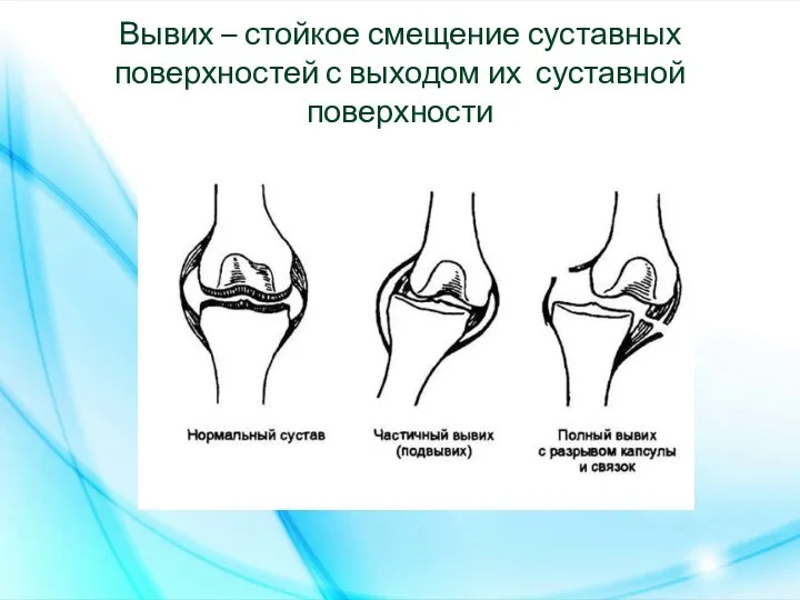 Вывих – стойкое смещение суставных поверхностей с выходом их суставной поверхности