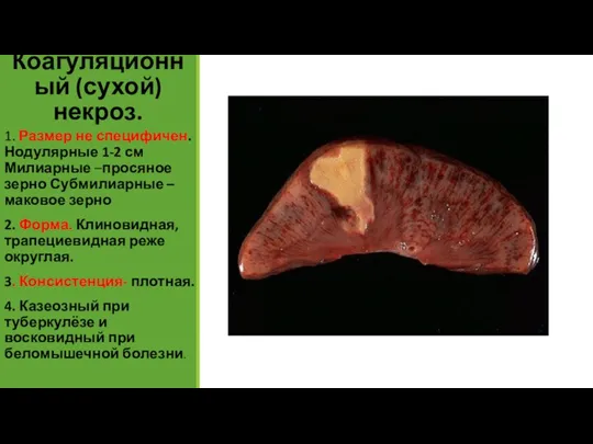 Коагуляционный (сухой) некроз. 1. Размер не специфичен. Нодулярные 1-2 см Милиарные –просяное