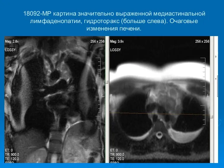 18092-МР картина значительно выраженной медиастинальной лимфаденопатии, гидроторакс (больше слева). Очаговые изменения печени.