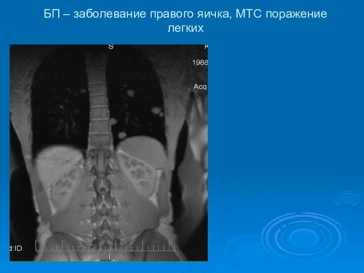 БП – заболевание правого яичка, МТС поражение легких