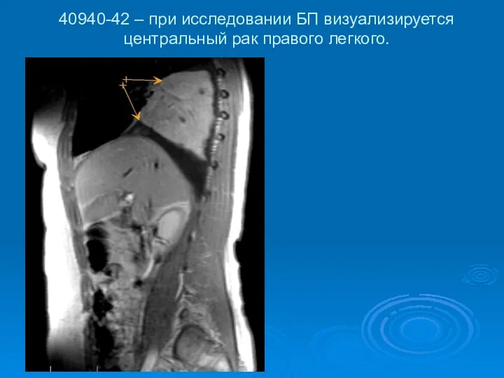 40940-42 – при исследовании БП визуализируется центральный рак правого легкого.