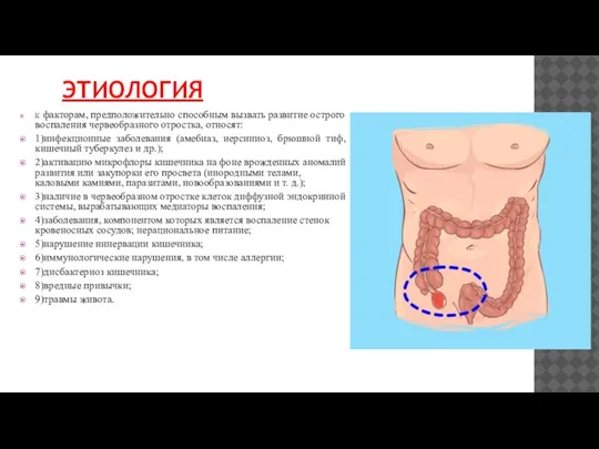 ЭТИОЛОГИЯ К факторам, предположительно способным вызвать развитие острого воспаления червеобразного отростка, относят: