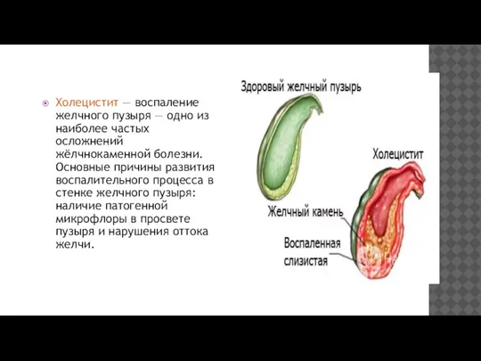 Холецистит — воспаление желчного пузыря — одно из наиболее частых осложнений жёлчнокаменной