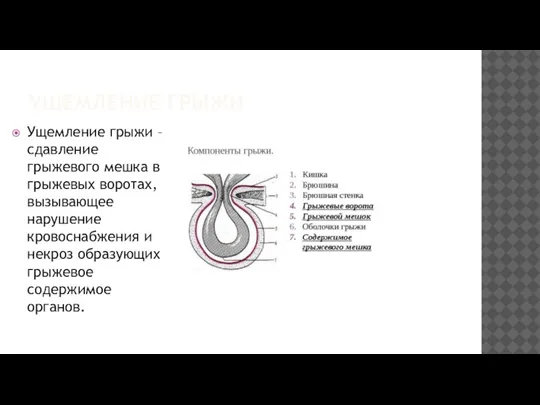 УЩЕМЛЕНИЕ ГРЫЖИ Ущемление грыжи – сдавление грыжевого мешка в грыжевых воротах, вызывающее