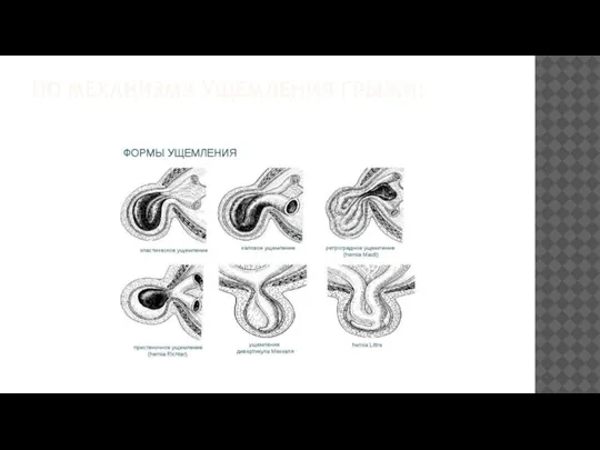 ПО МЕХАНИЗМУ УЩЕМЛЕНИЯ ГРЫЖИ: