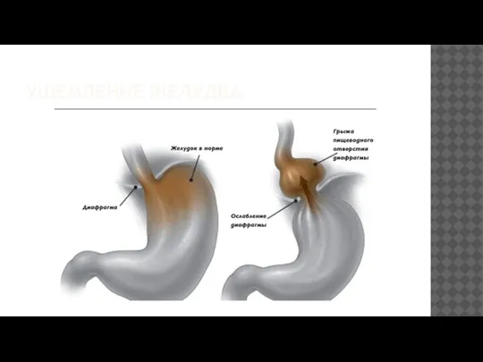 УЩЕМЛЕНИЕ ЖЕЛУДКА