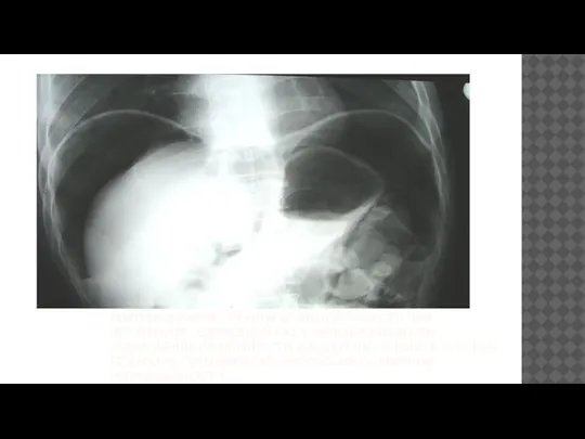 РЕНТГЕНОГРАФИЯ ОРГАНОВ БРЮШНОЙ ПОЛОСТИ ПРИ ПЕРИТОНИТЕ. СВОБОДНЫЙ ГАЗ В БРЮШНОЙ ПОЛОСТИ, ОГРАНИЧЕНИЕ
