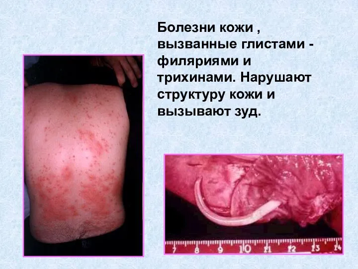 Болезни кожи , вызванные глистами - филяриями и трихинами. Нарушают структуру кожи и вызывают зуд.