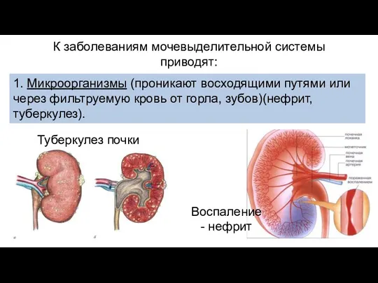 К заболеваниям мочевыделительной системы приводят: 1. Микроорганизмы (проникают восходящими путями или через