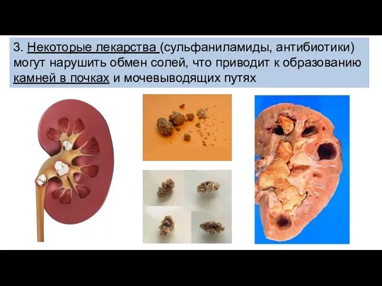 3. Некоторые лекарства (сульфаниламиды, антибиотики) могут нарушить обмен солей, что приводит к