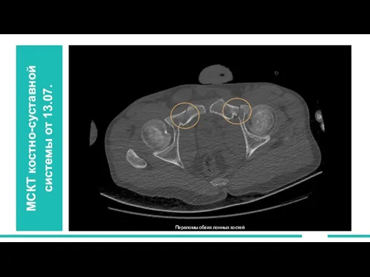 МСКТ костно-суставной системы от 13.07. Переломы обеих лонных костей