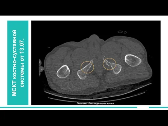 МСКТ костно-суставной системы от 13.07. Переломы обеих седалищных костей
