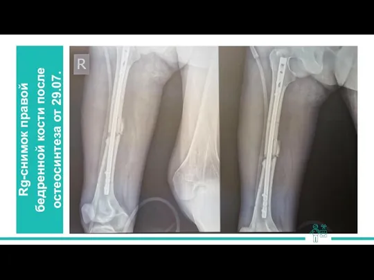 Rg-снимок правой бедренной кости после остеосинтеза от 29.07.