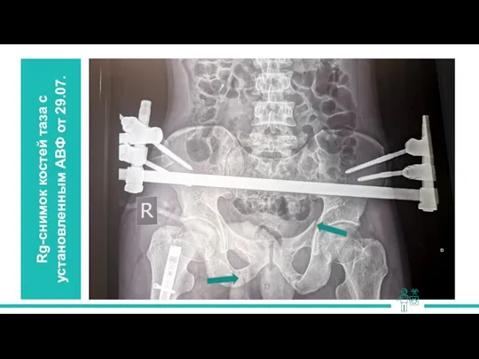Rg-снимок костей таза с установленным АВФ от 29.07.