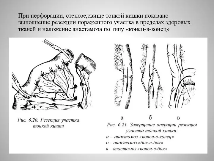 При перфорации, стенозе,свище тонкой кишки показано выполнение резекции пораженного участка в пределах