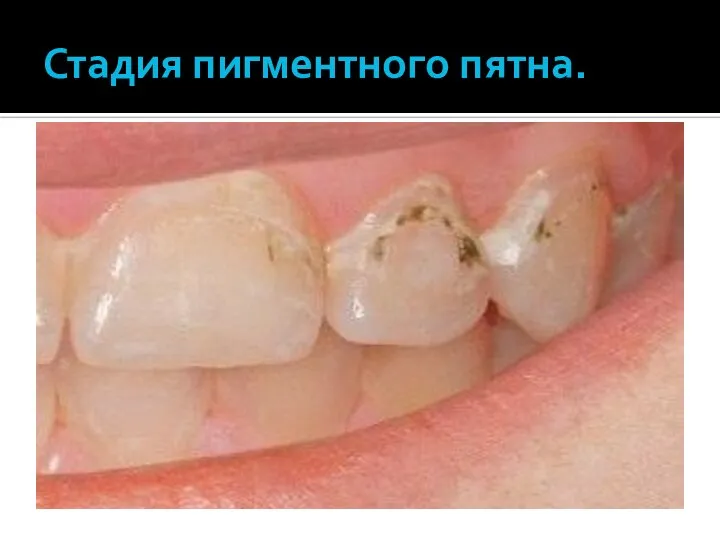 Стадия пигментного пятна.