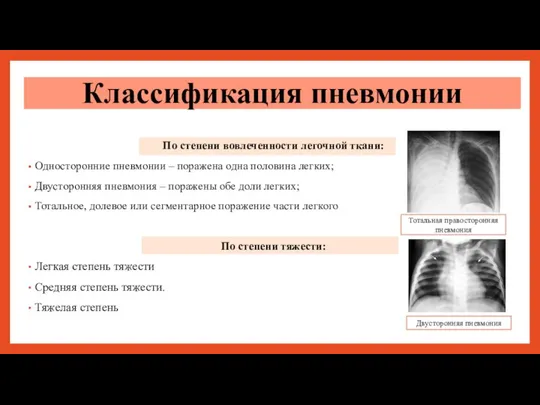 По степени вовлеченности легочной ткани: Односторонние пневмонии – поражена одна половина легких;