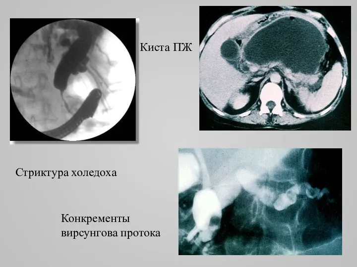 Киста ПЖ Стриктура холедоха Конкременты вирсунгова протока