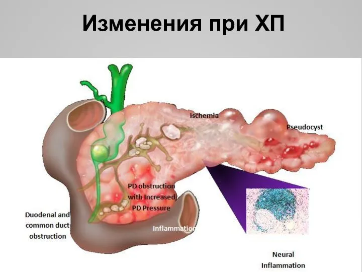 Изменения при ХП