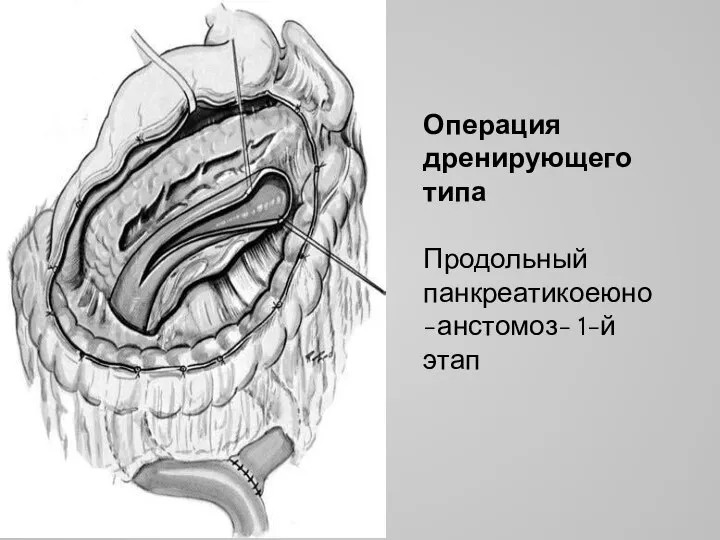 Операция дренирующего типа Продольный панкреатикоеюно-анстомоз- 1-й этап