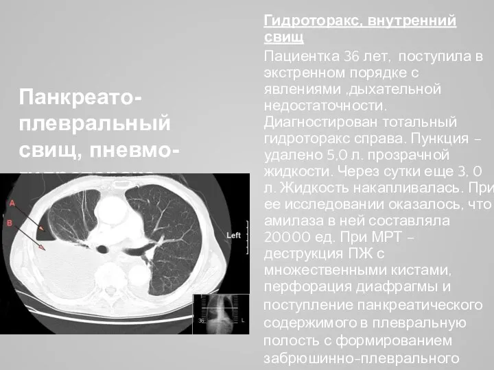 Панкреато-плевральный свищ, пневмо-гидроторакс справа Гидроторакс, внутренний свищ Пациентка 36 лет, поступила в