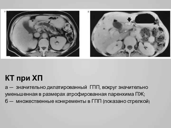 КТ при ХП а — значительно дилатированный ГПП, вокруг значительно уменьшенная в