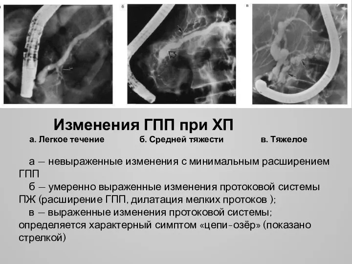 Изменения ГПП при ХП а. Легкое течение б. Средней тяжести в. Тяжелое