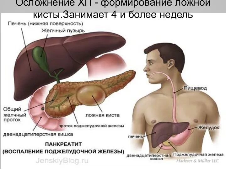 Осложнение ХП - формирование ложной кисты.Занимает 4 и более недель