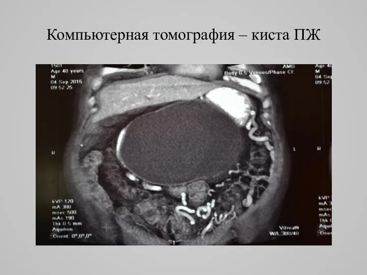 Компьютерная томография – киста ПЖ