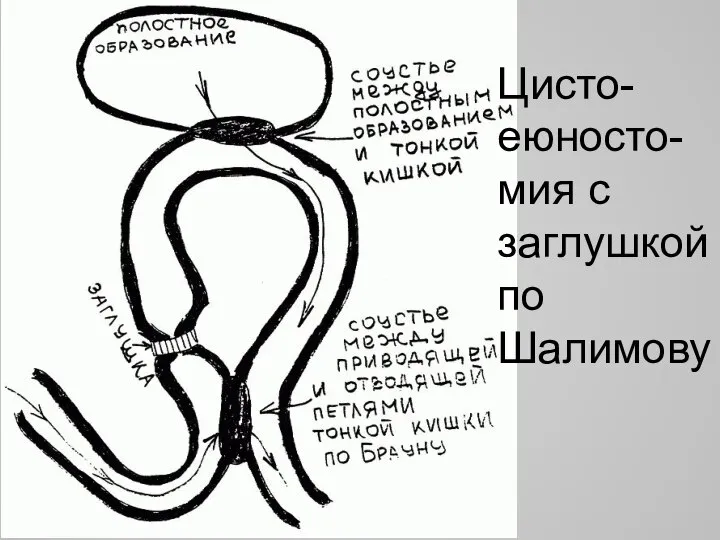 Цисто-еюносто-мия с заглушкой по Шалимову