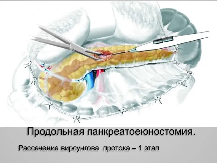 Продольная панкреатоеюностомия. Рассечение вирсунгова протока – 1 этап