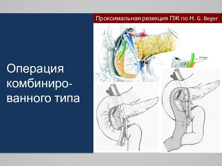 Операция комбиниро-ванного типа Проксимальная резекция ПЖ по Н. G. Beger