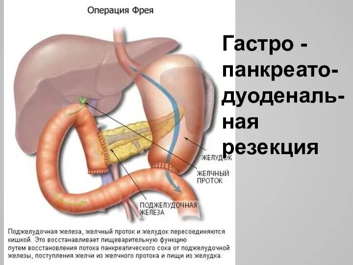 Гастро - панкреато-дуоденаль- ная резекция