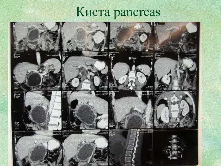 Киста pancreas