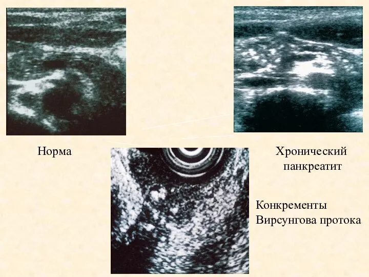 Норма Хронический панкреатит Конкременты Вирсунгова протока