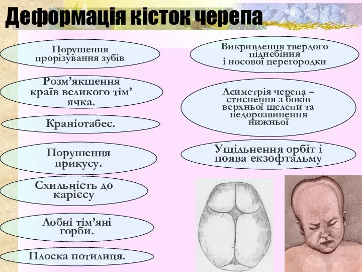 Деформація кісток черепа Краніотабес. Розм’якшення країв великого тім’ячка. Лобні тім’яні горби. Порушення