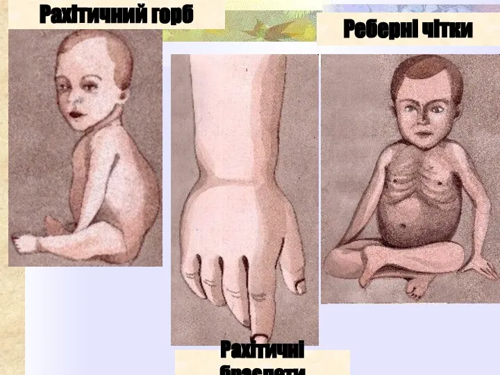Рахітичний горб Рахітичні браслети Реберні чітки