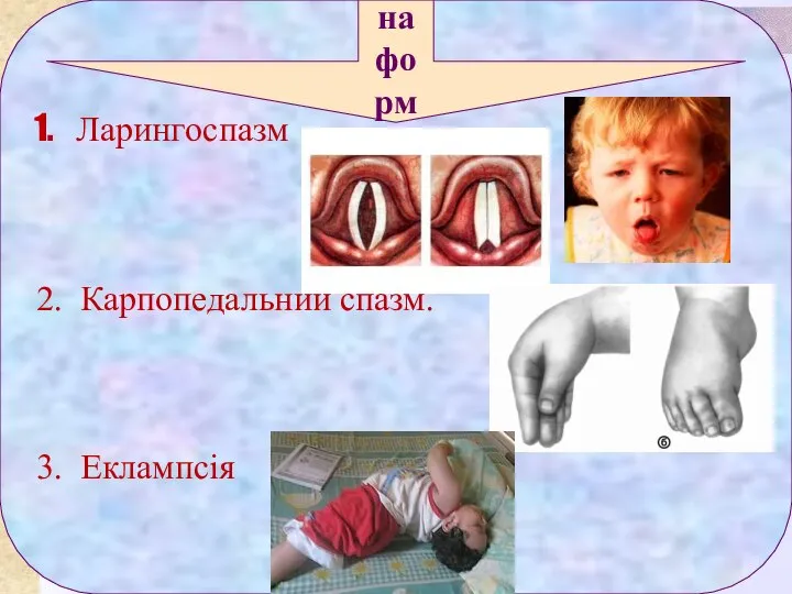 Ларингоспазм 2. Карпопедальний спазм. 3. Еклампсія Маніфестна форма (явна)