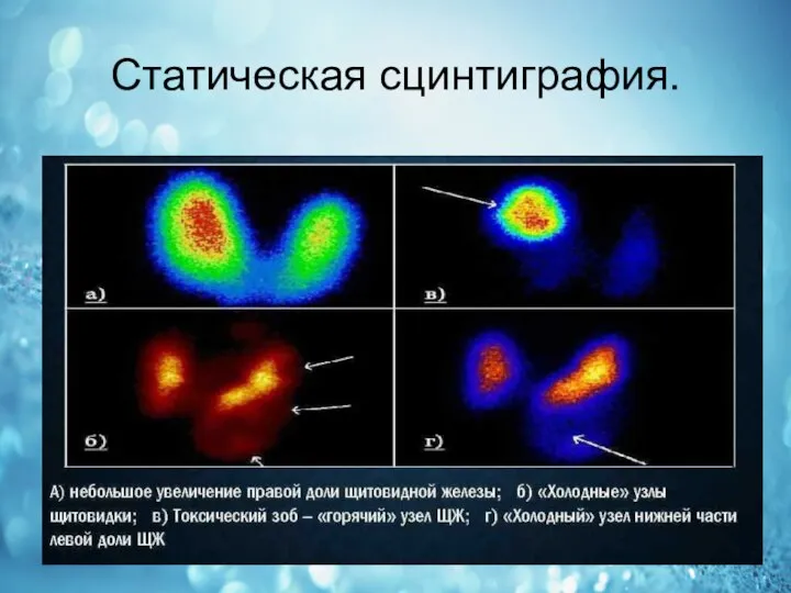 Статическая сцинтиграфия.