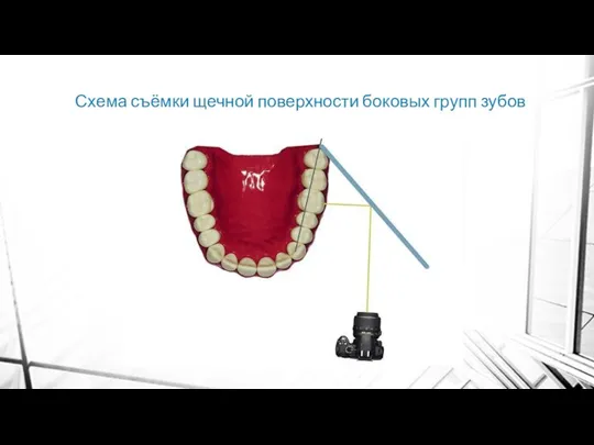 Схема съёмки щечной поверхности боковых групп зубов