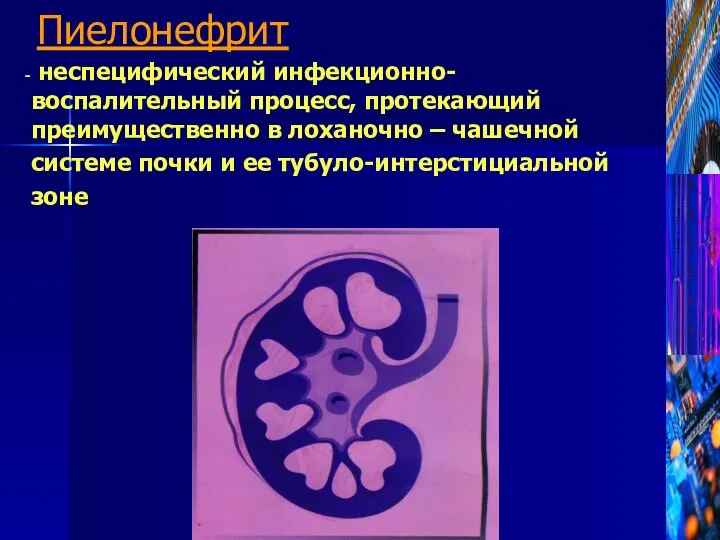 Пиелонефрит неспецифический инфекционно-воспалительный процесс, протекающий преимущественно в лоханочно – чашечной системе почки и ее тубуло-интерстициальной зоне