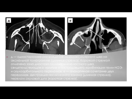 д — одностороннее расхождение назомаксиллярного шва на аксиальной томограмме (длинная стрелка). Короткой