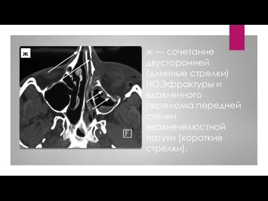 ж — сочетание двусторонней (длинные стрелки) НОЭфрактуры и вдавленного перелома передней стенки верхнечелюстной пазухи (короткие стрелки).