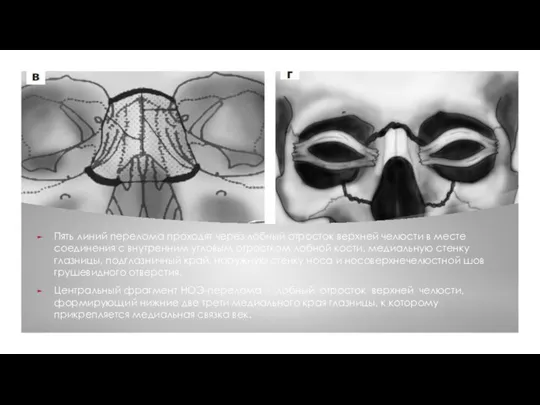 Пять линий перелома проходят через лобный отросток верхней челюсти в месте соединения
