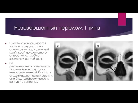 Незавершенный перелом 1 типа Пластина накладывается лишь на зону диастаза отломков —