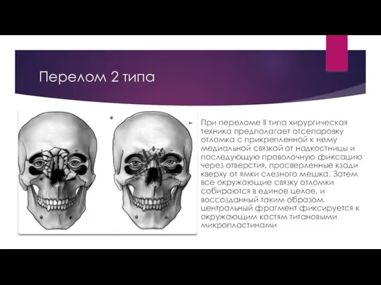 Перелом 2 типа При переломе II типа хирургическая техника предполагает отсепаровку отломка