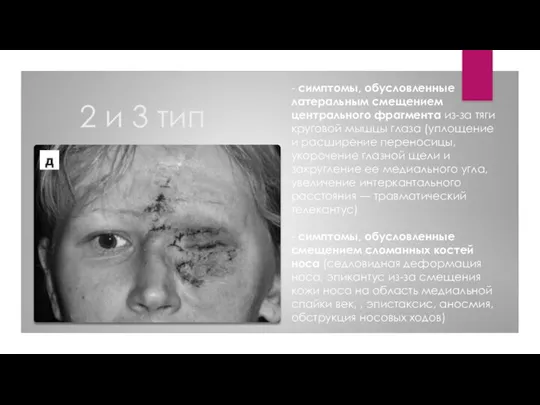 2 и 3 тип - симптомы, обусловленные латеральным смещением центрального фрагмента из-за