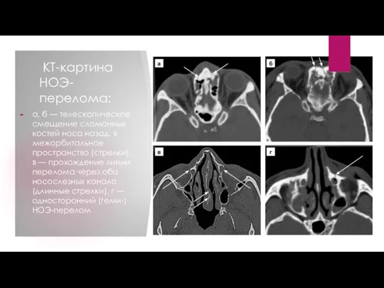 КТ-картина НОЭ-перелома: а, б — телескопическое смещение сломанных костей носа назад, в